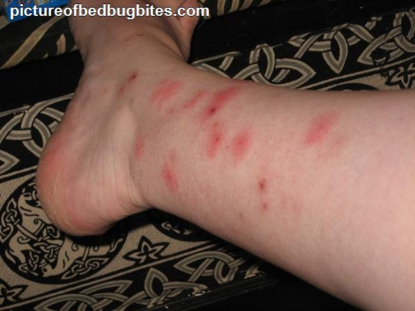 leg with bed bug bites
