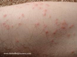 bed bug bites